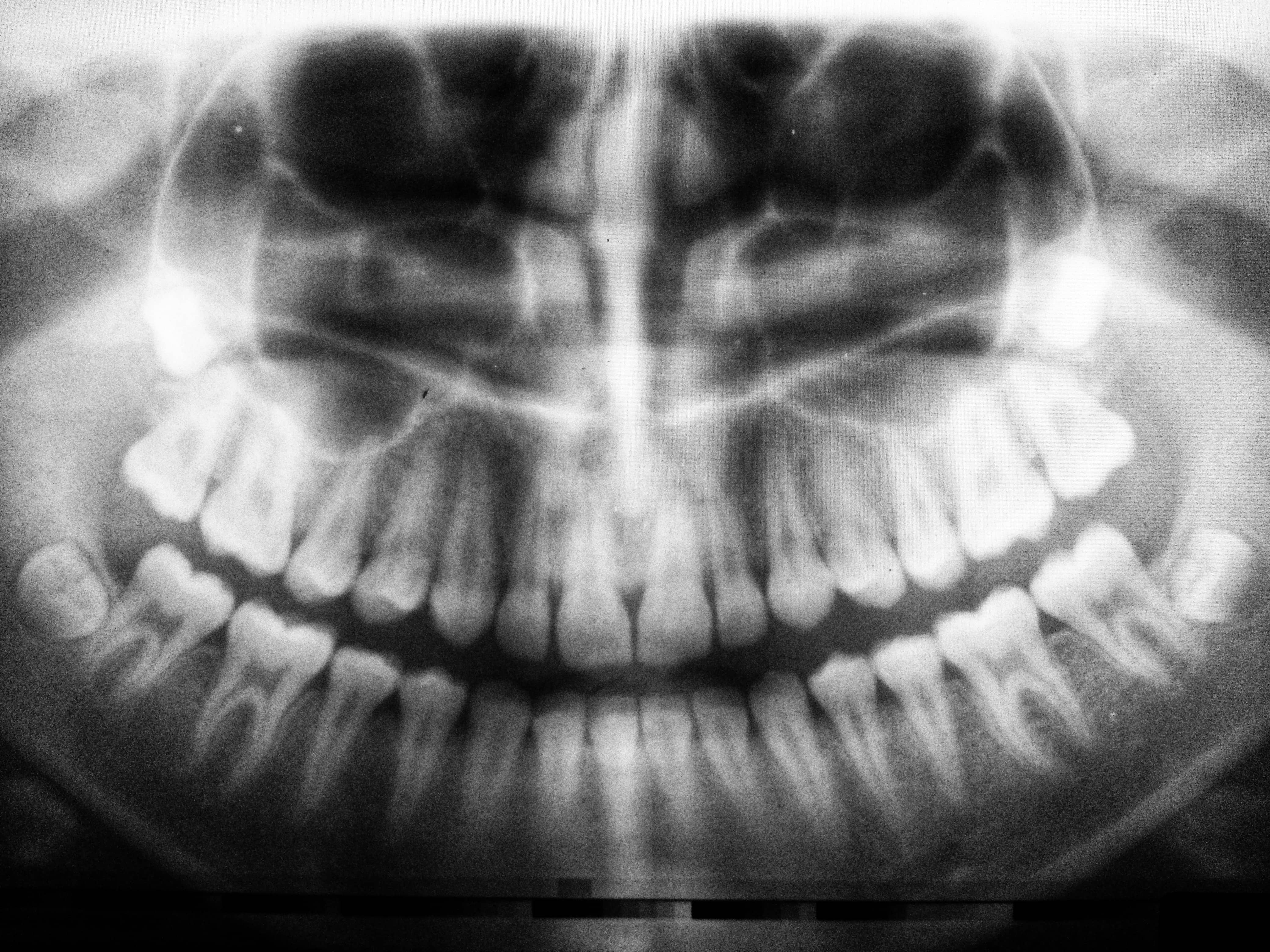 image d'une radio de dents